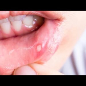 HPV - Doença grave que pode não dar sintomas Dr Dayan Siebra